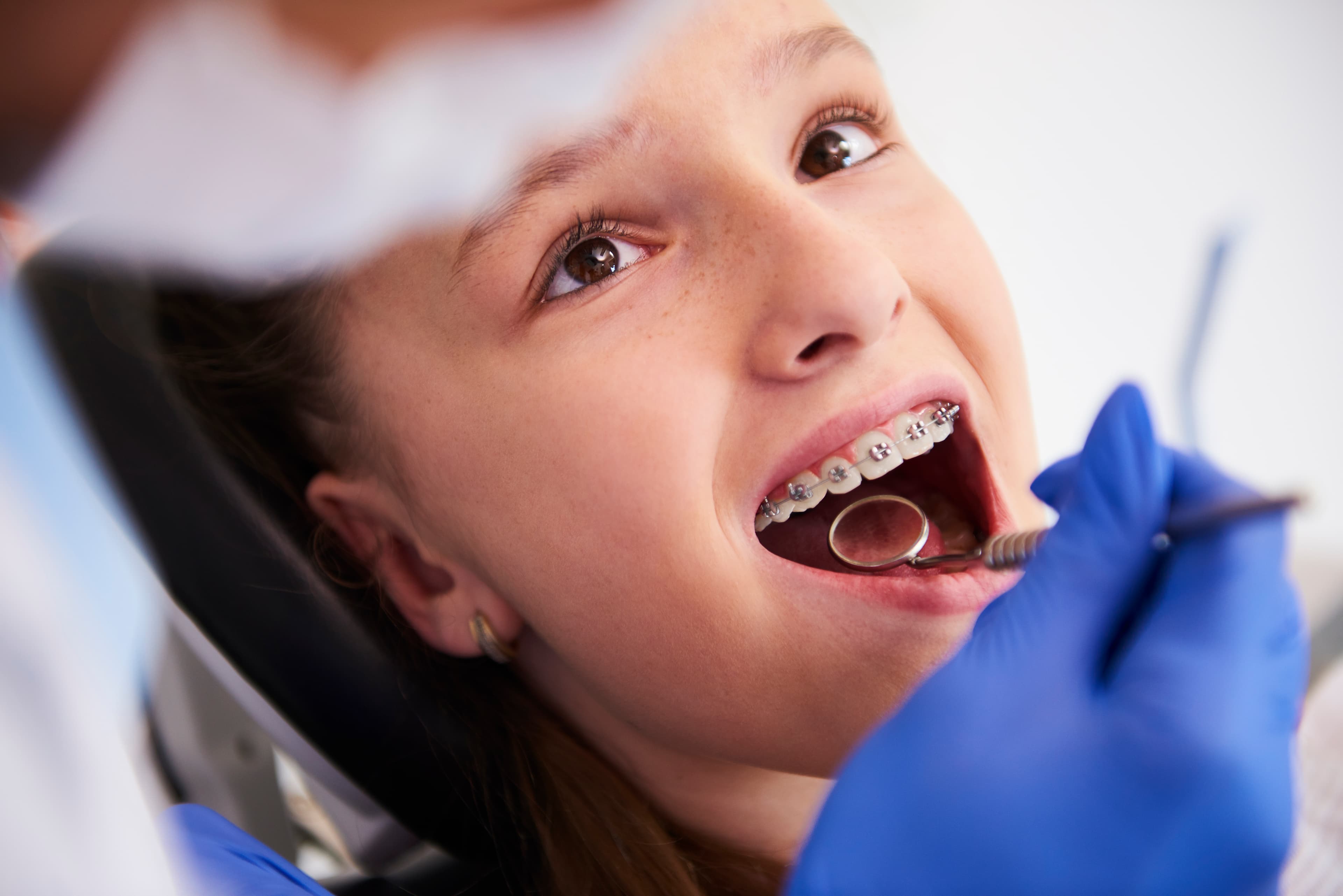 Braces Treatment in Vijayawada (Metal & Ceramic)